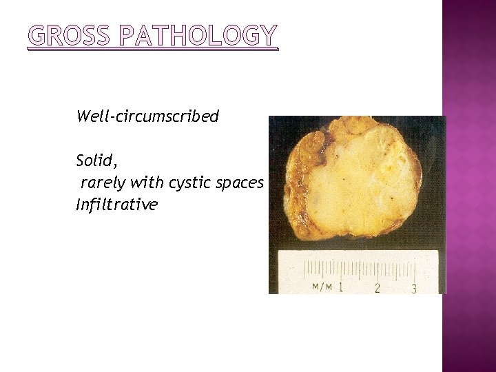GROSS PATHOLOGY Well-circumscribed Solid, rarely with cystic spaces Infiltrative 