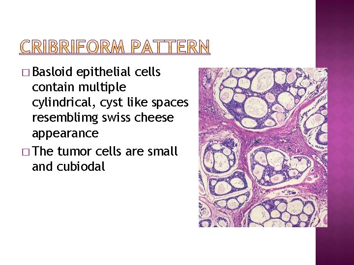 � Basloid epithelial cells contain multiple cylindrical, cyst like spaces resemblimg swiss cheese appearance