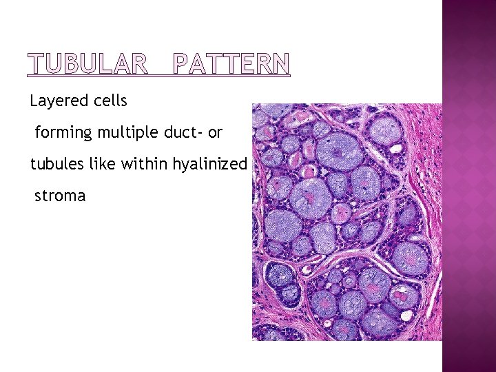 TUBULAR PATTERN Layered cells forming multiple duct- or tubules like within hyalinized stroma 