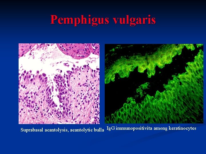 Pemphigus vulgaris Suprabasal acantolysis, acantolytic bulla Ig. G immunopositivita among keratinocytes 