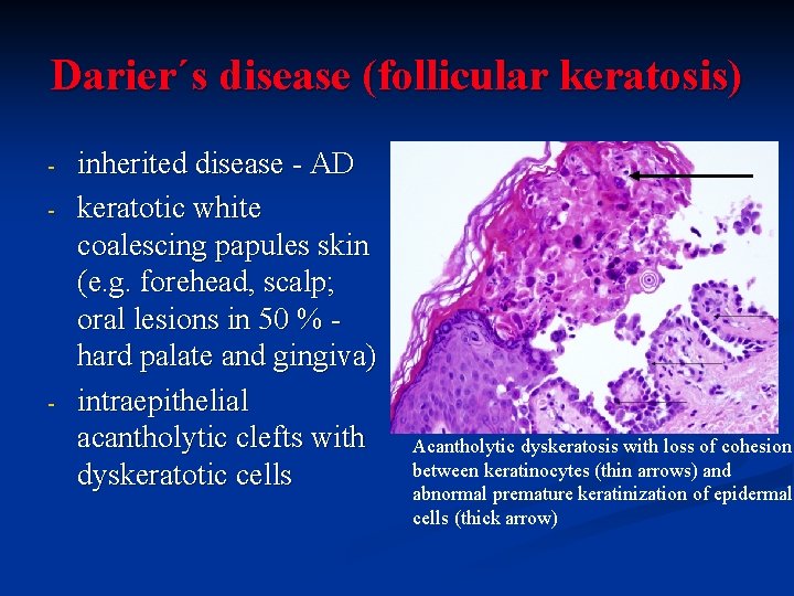 Darier´s disease (follicular keratosis) - - inherited disease - AD keratotic white coalescing papules