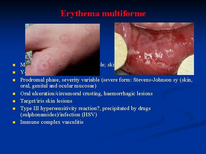 Erythema multiforme n n n n Mucosal vesicles and bullae variable; skin and mucous