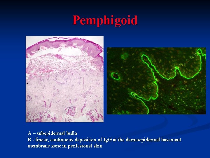 Pemphigoid A – subepidermal bulla B - linear, continuous deposition of Ig. G at