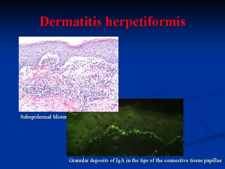 Dermatitis herpetiformis Subepidermal blister Granular deposits of Ig. A in the tips of the