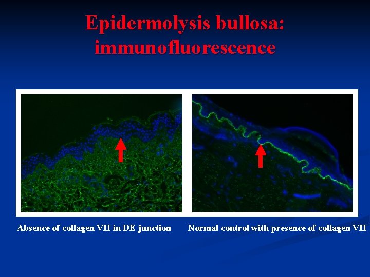 Epidermolysis bullosa: immunofluorescence Absence of collagen VII in DE junction Normal control with presence