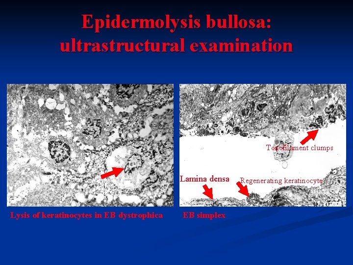 Epidermolysis bullosa: ultrastructural examination Tonofilament clumps Lamina densa Lysis of keratinocytes in EB dystrophica