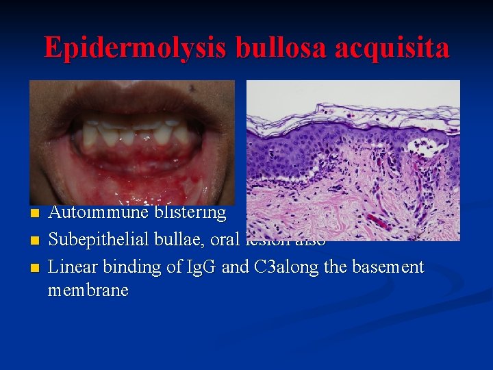 Epidermolysis bullosa acquisita n n n Autoimmune blistering Subepithelial bullae, oral lesion also Linear