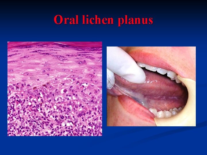 Oral lichen planus 