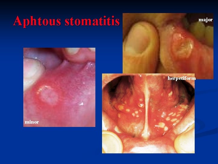 Aphtous stomatitis major herpetiform minor 