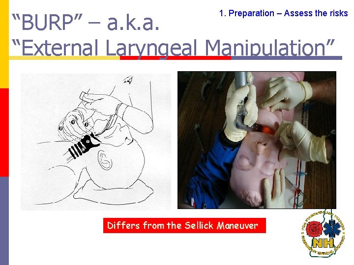 “BURP” – a. k. a. “External Laryngeal Manipulation” 1. Preparation – Assess the risks