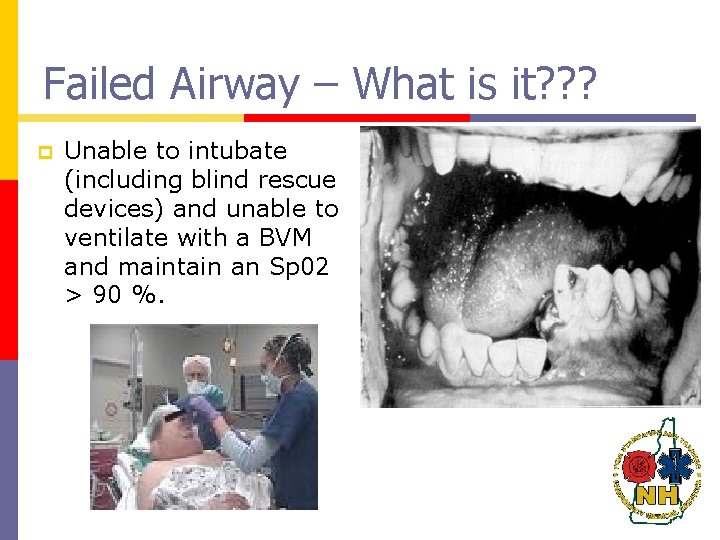 Failed Airway – What is it? ? ? p Unable to intubate (including blind