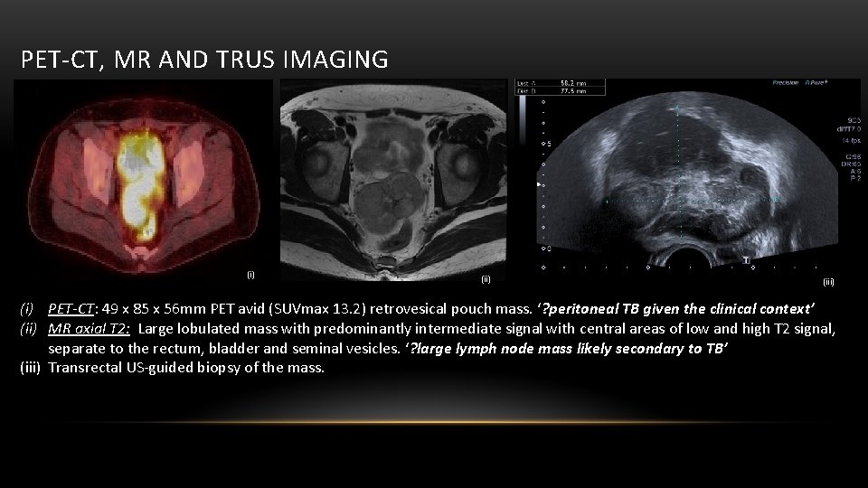 PET-CT, MR AND TRUS IMAGING (i) (iii) (i) PET-CT: 49 x 85 x 56