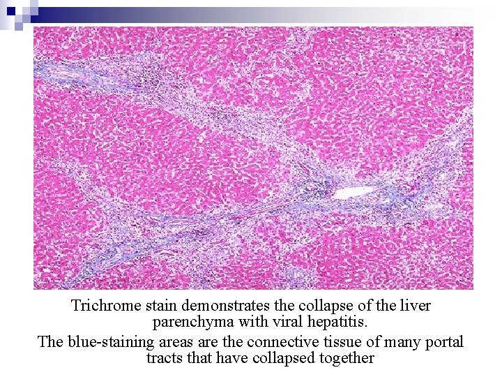 Trichrome stain demonstrates the collapse of the liver parenchyma with viral hepatitis. The blue-staining