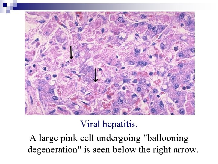 Viral hepatitis. A large pink cell undergoing "ballooning degeneration" is seen below the right