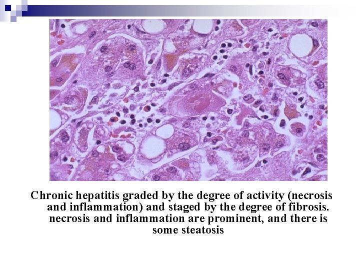 Chronic hepatitis graded by the degree of activity (necrosis and inflammation) and staged by