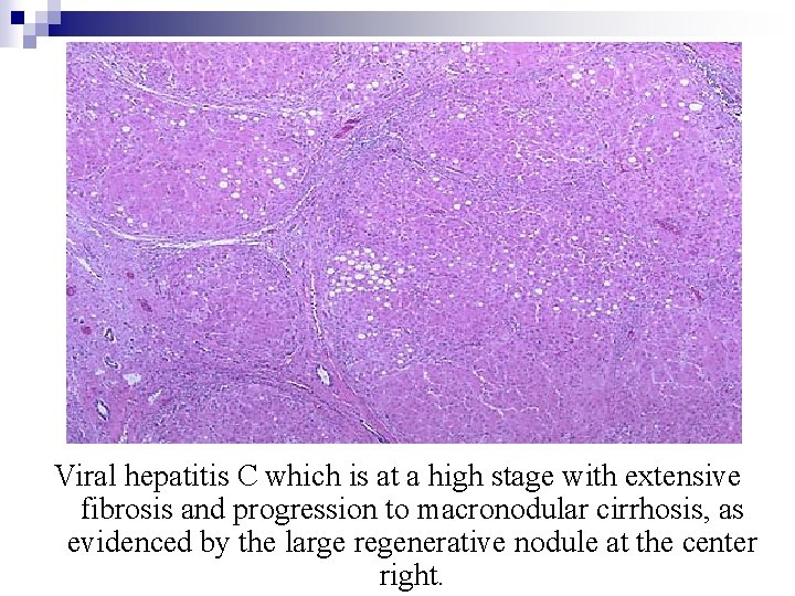Viral hepatitis C which is at a high stage with extensive fibrosis and progression