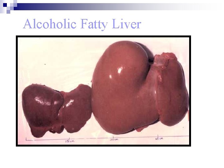 Alcoholic Fatty Liver 