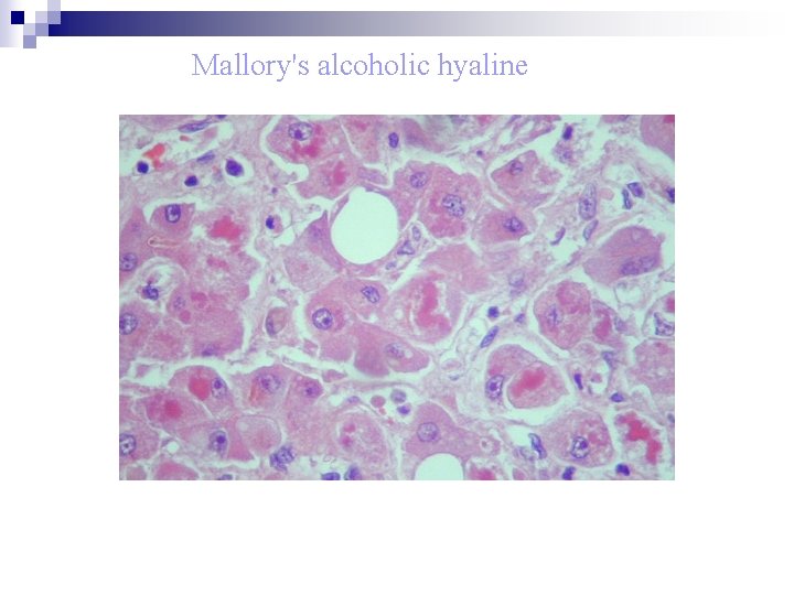 Mallory's alcoholic hyaline 
