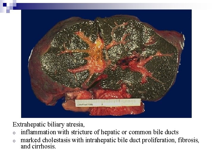 Extrahepatic biliary atresia, o inflammation with stricture of hepatic or common bile ducts o
