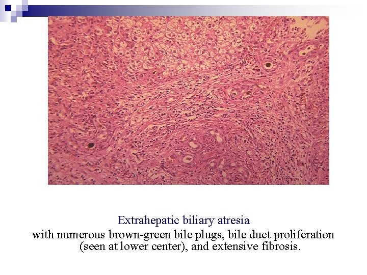 Extrahepatic biliary atresia with numerous brown-green bile plugs, bile duct proliferation (seen at lower