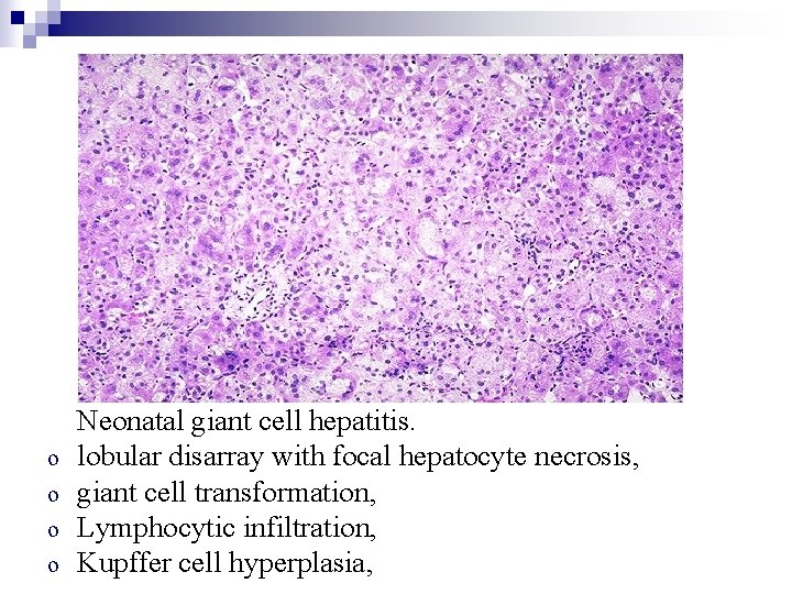 o o Neonatal giant cell hepatitis. lobular disarray with focal hepatocyte necrosis, giant cell