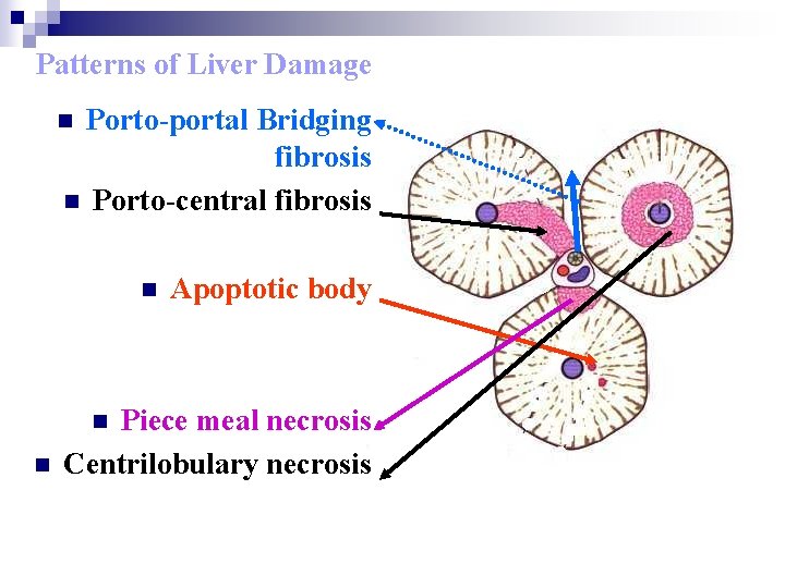 Patterns of Liver Damage Porto-portal Bridging fibrosis n Porto-central fibrosis n n Piece meal
