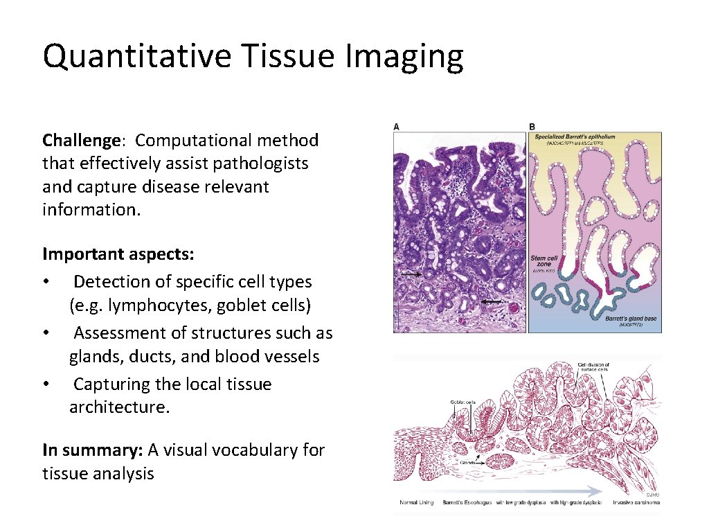 Quantitative Tissue Imaging Challenge: Computational method that effectively assist pathologists and capture disease relevant