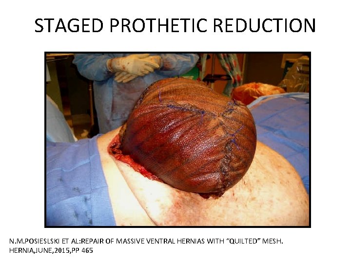 STAGED PROTHETIC REDUCTION N. M. POSIESLSKI ET AL: REPAIR OF MASSIVE VENTRAL HERNIAS WITH