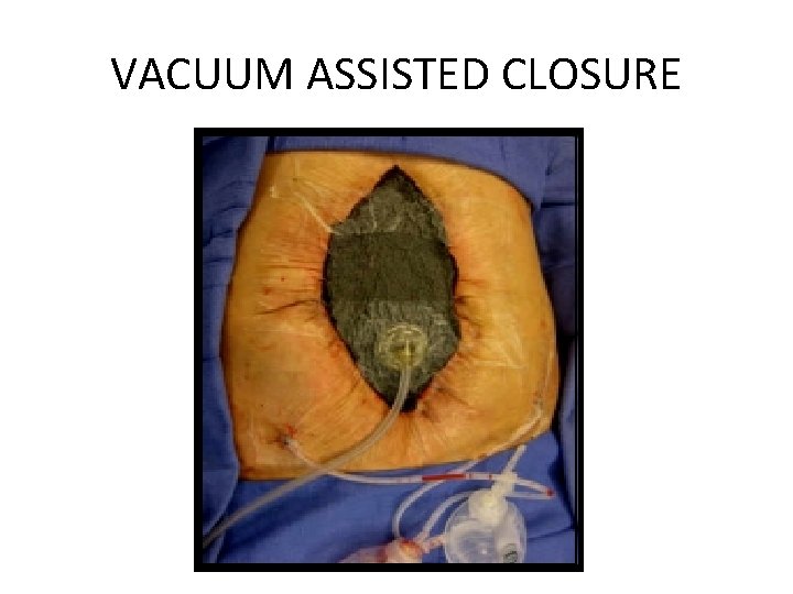 VACUUM ASSISTED CLOSURE 