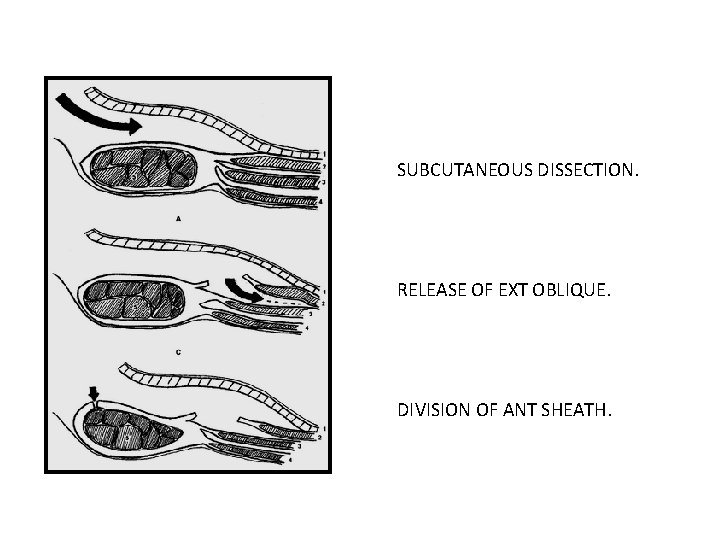 SUBCUTANEOUS DISSECTION. RELEASE OF EXT OBLIQUE. DIVISION OF ANT SHEATH. 