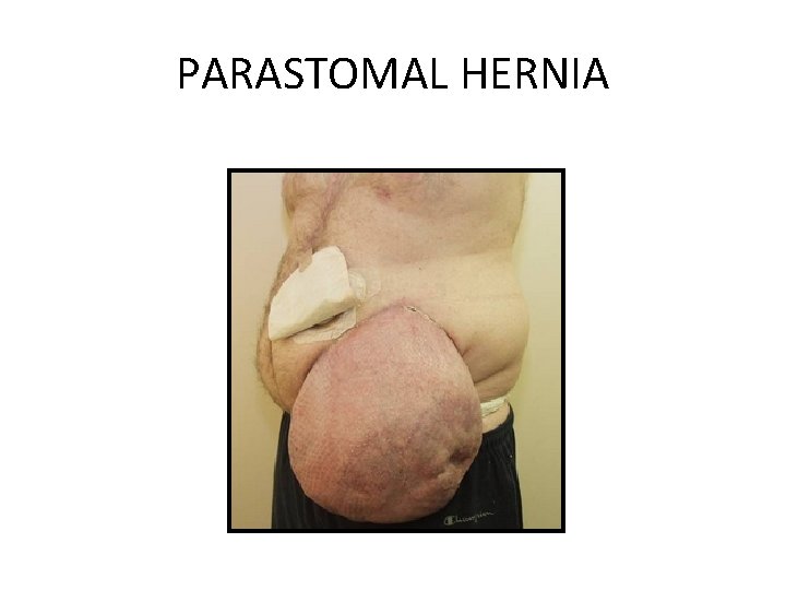 PARASTOMAL HERNIA 