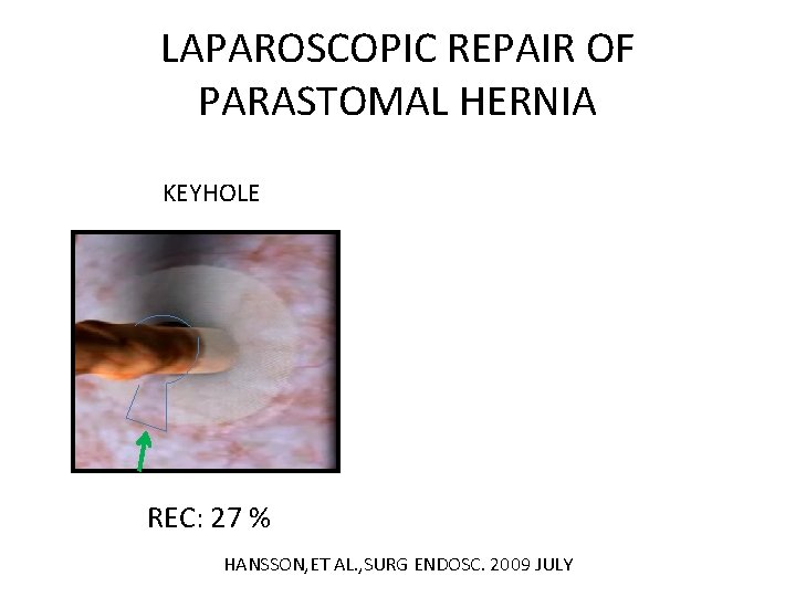 LAPAROSCOPIC REPAIR OF PARASTOMAL HERNIA KEYHOLE REC: 27 % HANSSON, ET AL. , SURG