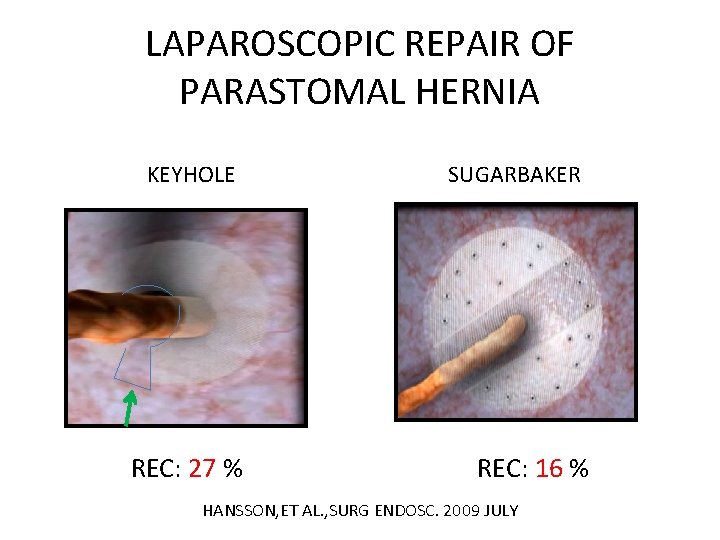 LAPAROSCOPIC REPAIR OF PARASTOMAL HERNIA KEYHOLE REC: 27 % SUGARBAKER REC: 16 % HANSSON,