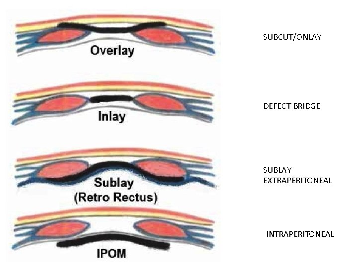 SUBCUT/ONLAY DEFECT BRIDGE SUBLAY EXTRAPERITONEAL INTRAPERITONEAL 