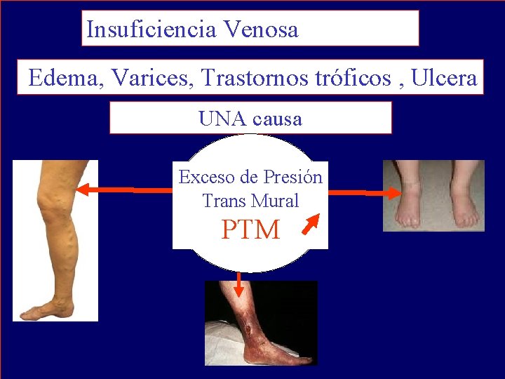 Insuficiencia Venosa Edema, Varices, Trastornos tróficos , Ulcera UNA causa Exceso de Presión Trans