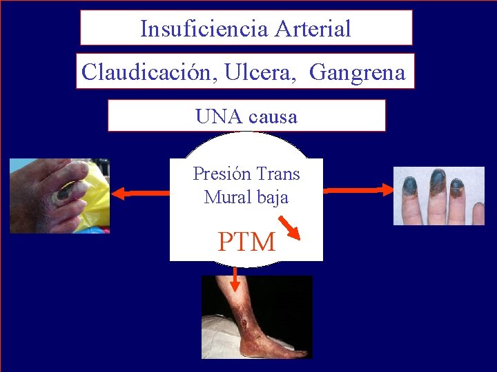 Insuficiencia Arterial Claudicación, Ulcera, Gangrena UNA causa Presión Trans Mural baja PTM 