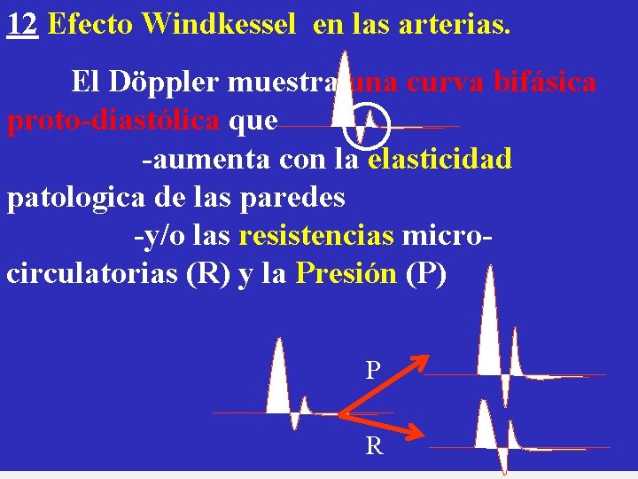 12 Efecto Windkessel en las arterias. El Döppler muestra una curva bifásica proto-diastólica que