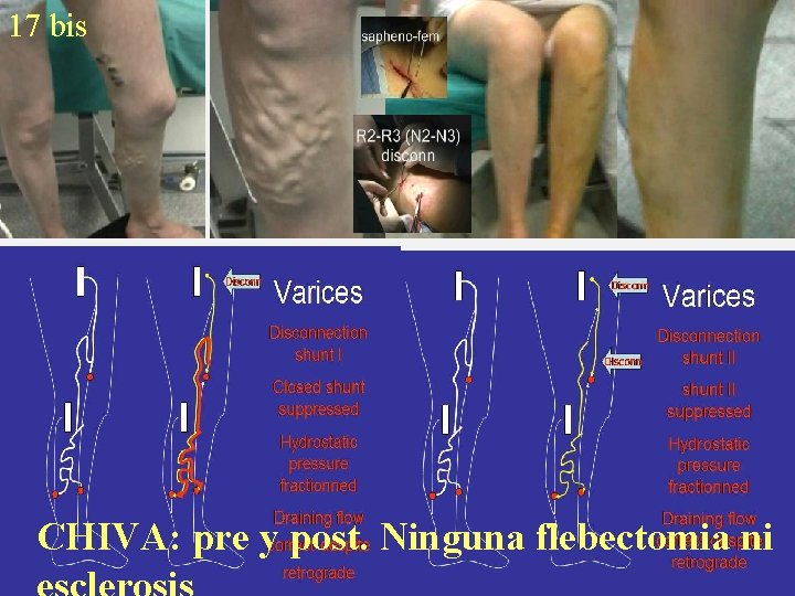 17 bis CHIVA: pre y post. Ninguna flebectomia ni 