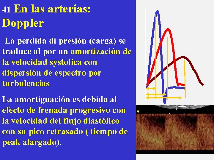 41 En las arterias: Doppler La perdida di presión (carga) se traduce al por