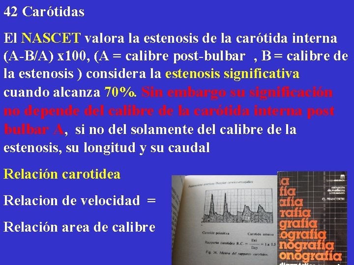 42 Carótidas El NASCET valora la estenosis de la carótida interna (A-B/A) x 100,