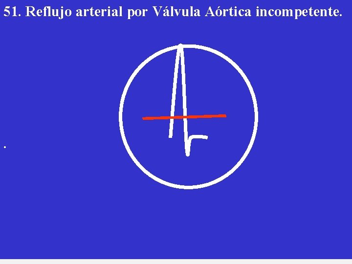 51. Reflujo arterial por Válvula Aórtica incompetente. . 