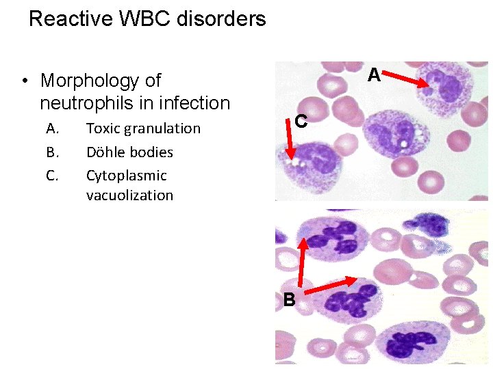 Reactive WBC disorders • Morphology of neutrophils in infection A. B. C. Toxic granulation