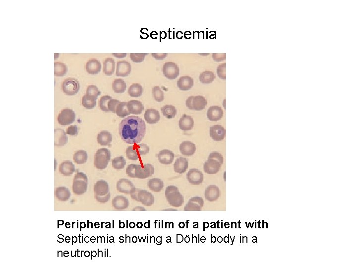 Septicemia Peripheral blood film of a patient with Septicemia showing a Döhle body in