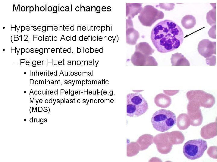 Morphological changes • Hypersegmented neutrophil (B 12, Folatic Acid deficiency) • Hyposegmented, bilobed –