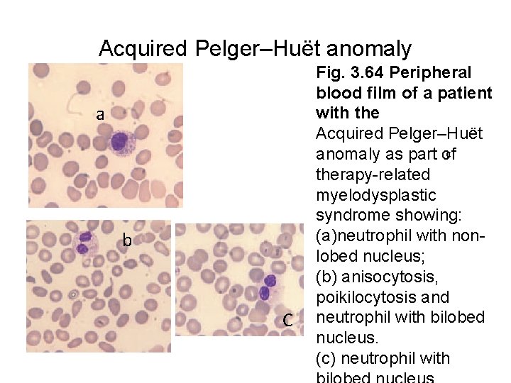 Acquired Pelger–Huët anomaly a b C Fig. 3. 64 Peripheral blood film of a