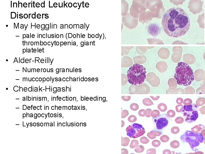 Inherited Leukocyte Disorders • May Hegglin anomaly – pale inclusion (Dohle body), thrombocytopenia, giant