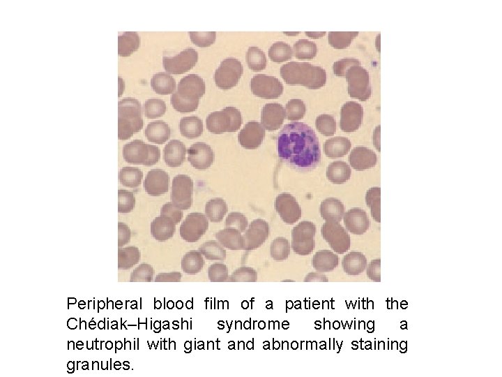 Peripheral blood film of a patient with the Chédiak–Higashi syndrome showing a neutrophil with