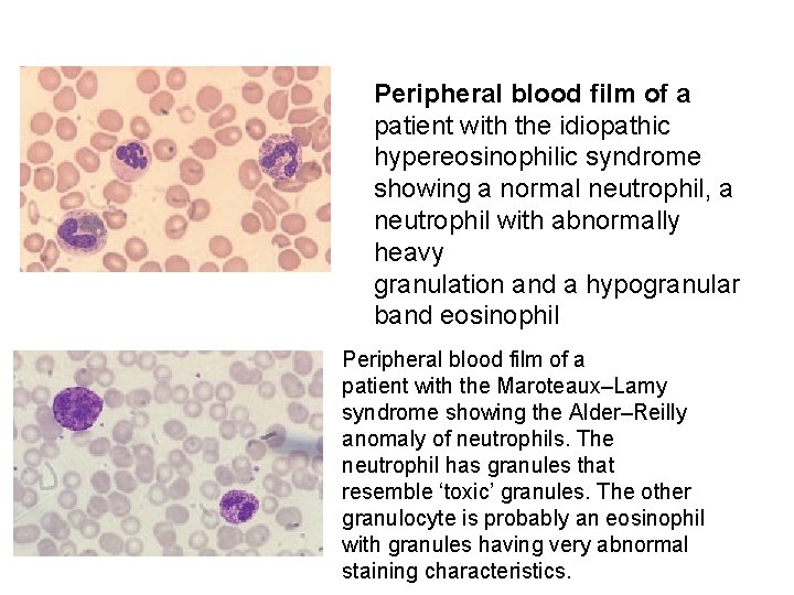 Peripheral blood film of a patient with the idiopathic hypereosinophilic syndrome showing a normal