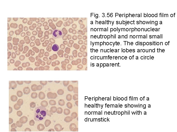 Fig. 3. 56 Peripheral blood film of a healthy subject showing a normal polymorphonuclear