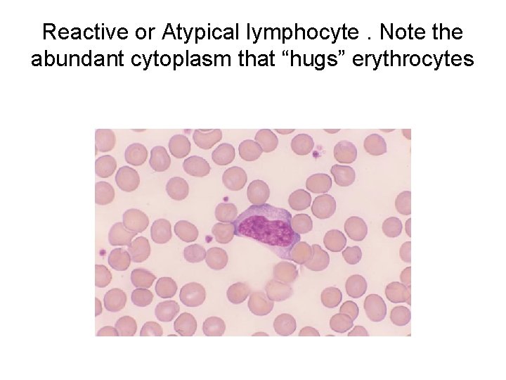 Reactive or Atypical lymphocyte. Note the abundant cytoplasm that “hugs” erythrocytes 